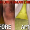 cara menghilangkan lutu hitam