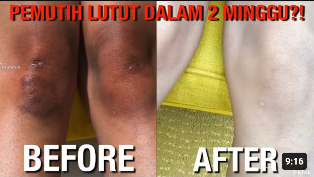 cara menghilangkan lutu hitam