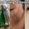 daun sirih untuk menghilangkan flek hitam di wajah