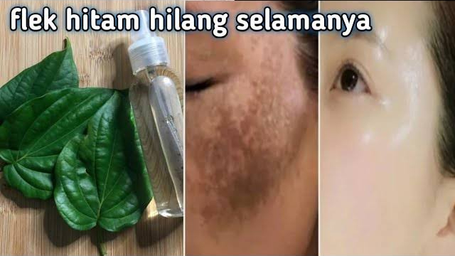 daun sirih untuk menghilangkan flek hitam di wajah