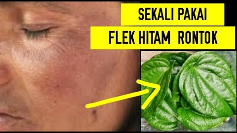 manfaat daun sirih untuk wajah flek hitam membandel