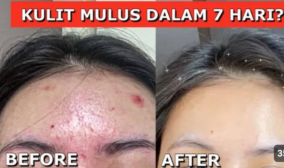 minyak zaitun untuk wajah bruntusan