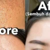 serum hanasui untuk bruntusan