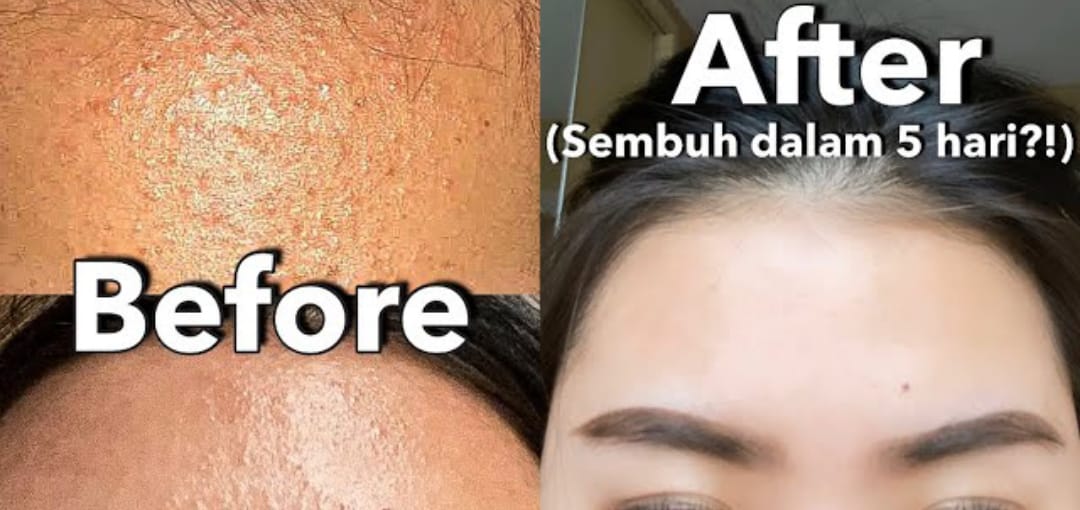 serum hanasui untuk bruntusan