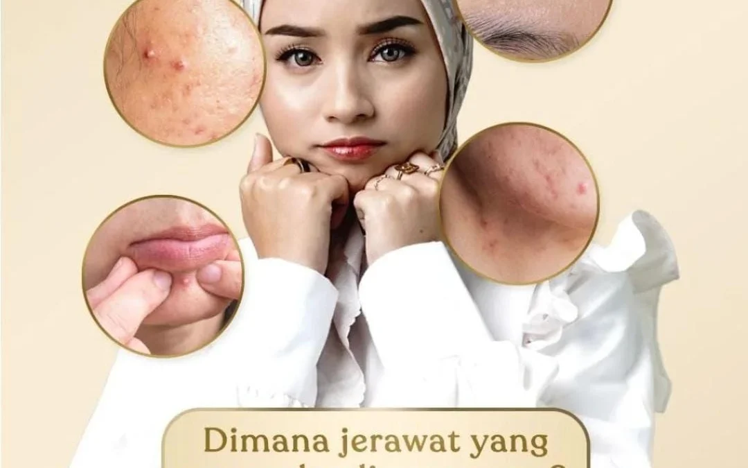 Cara Menghilangkan Jerawat Secara Alami