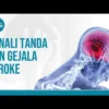 Cara Sederhana Kenali Gejala Stroke