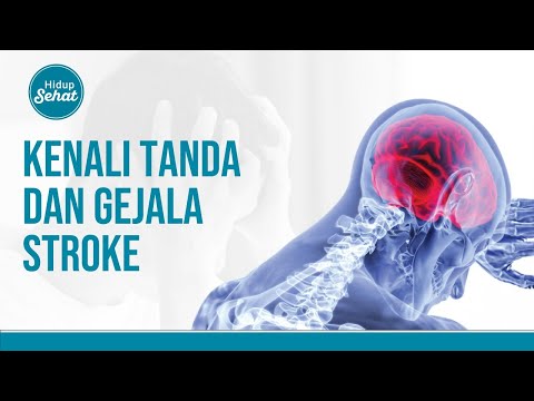 Cara Sederhana Kenali Gejala Stroke