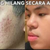 3 Cara Cepat Menghilangkan Jerawat dan Bekasnya dengan Bahan Alami Efektif Bikin Putih dan Glowing Tanpa Noda Hitam