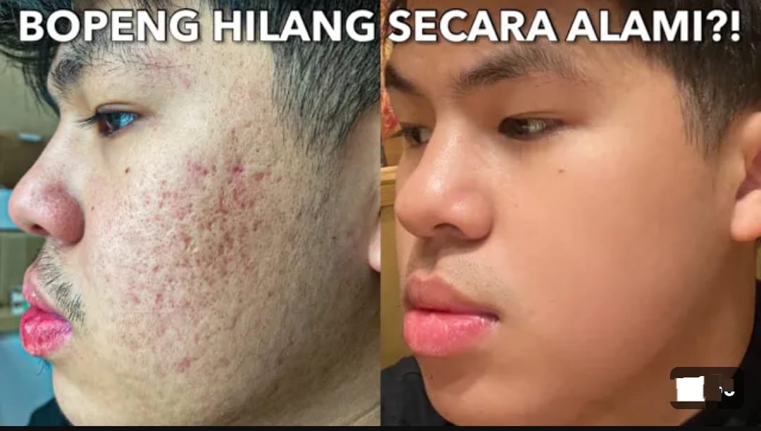 3 Cara Cepat Menghilangkan Jerawat dan Bekasnya dengan Bahan Alami Efektif Bikin Putih dan Glowing Tanpa Noda Hitam