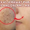 Cara Cepat Menghilangkan Jerawat Secara Permanen Pakai Bahan Alami