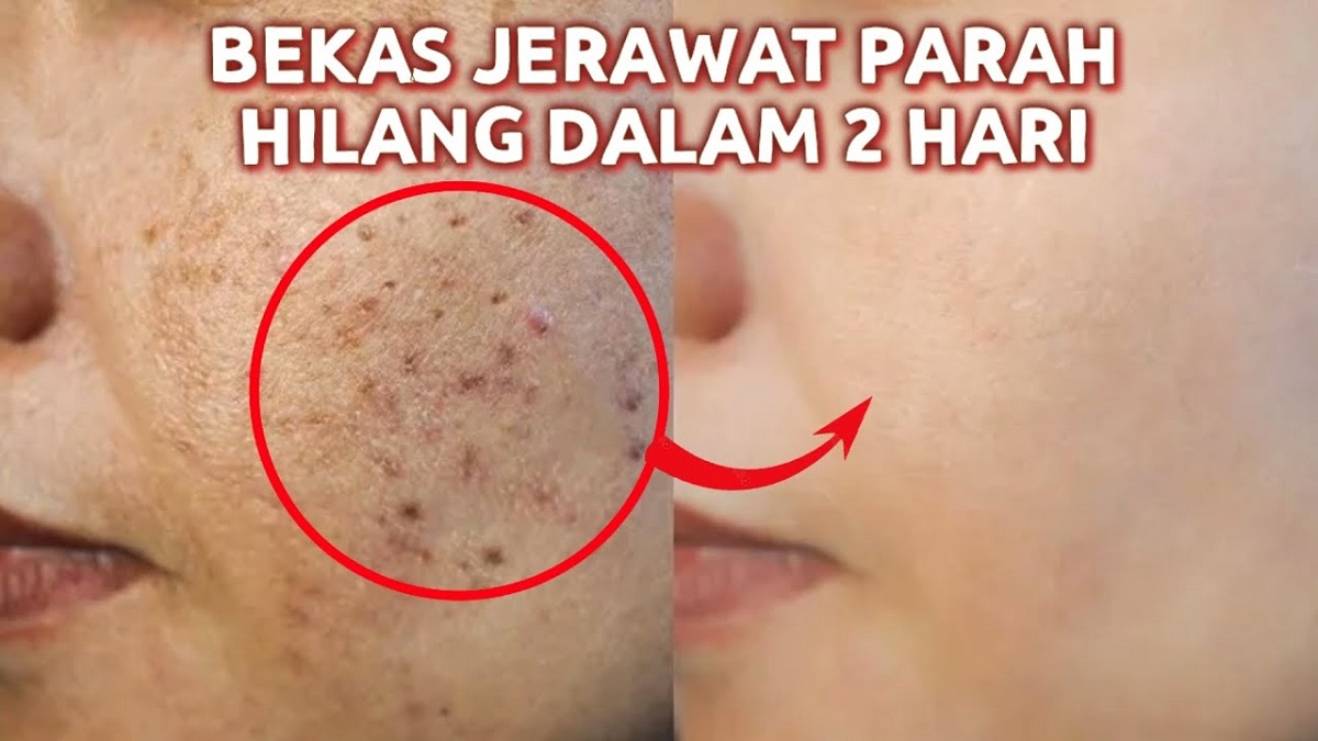 Cara Cepat Menghilangkan Jerawat Secara Permanen Pakai Bahan Alami