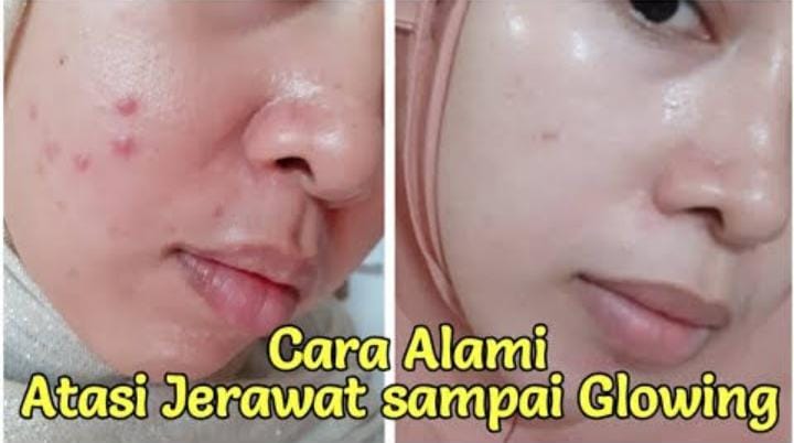 Cara mengatasi jerawat dengan alami dan cepat