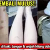 3 Bahan Dapur Pemutih Bekas Koreng Hitam di Kaki, Begini Cara Meraciknya