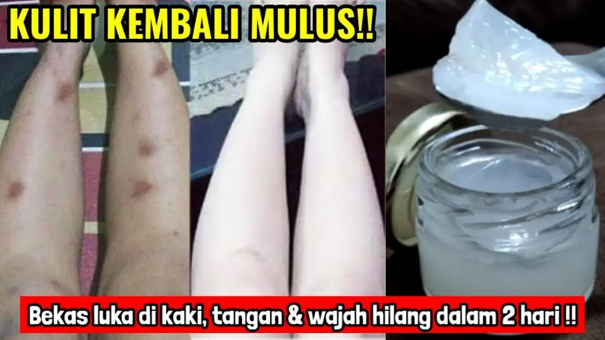 3 Bahan Dapur Pemutih Bekas Koreng Hitam di Kaki, Begini Cara Meraciknya