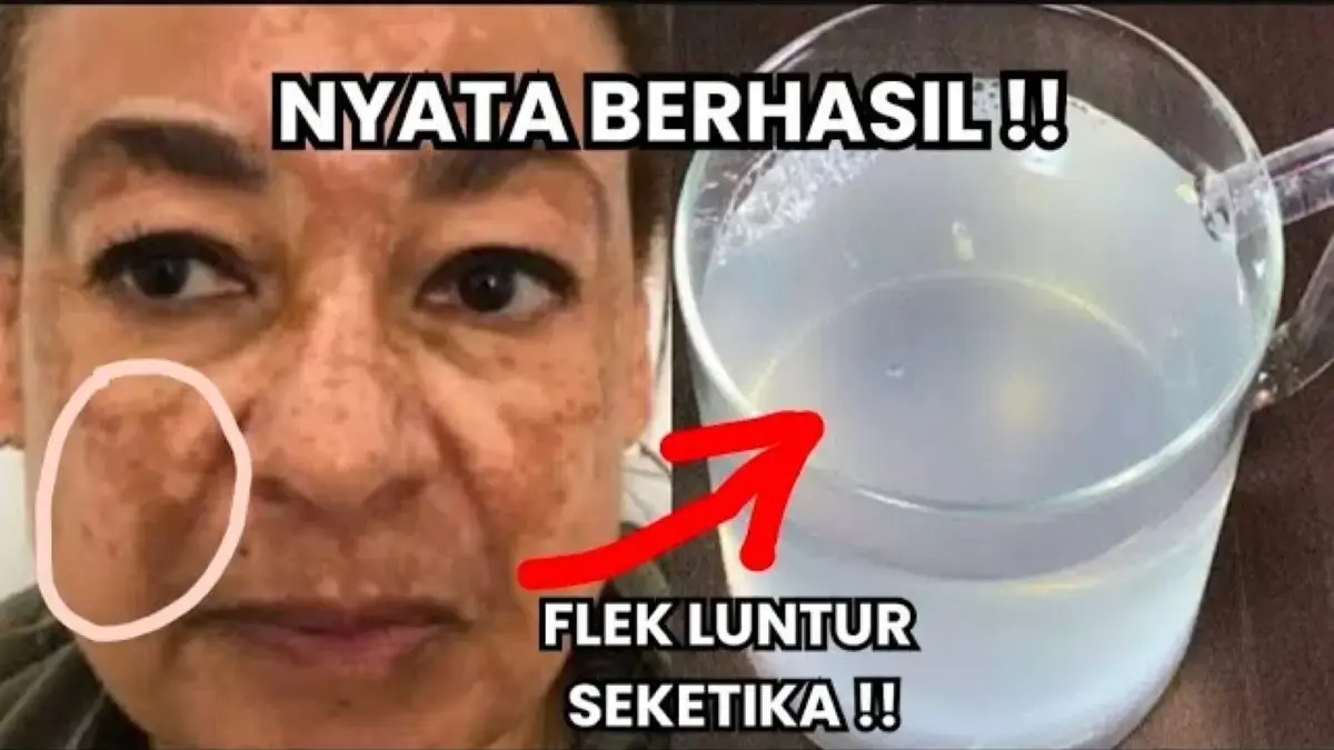 3 Cara Mengelupas Flek Hitam yang Cepat Tanpa Skincare