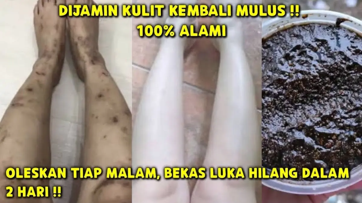 3 Cara Meracik Bahan Dapur untuk Menghilangkan Koreng di Kaki yang Menghitam, Langsung Mulus!