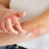 Menghilangkan Bekas Luka Secara Alami