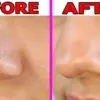 Cara Menghilangkan Komedo dengan Baking Soda