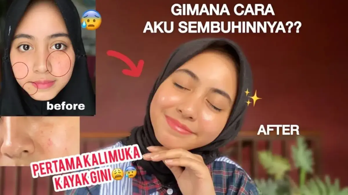 Masker Alami yang Cocok untuk Mengatasi Breakout