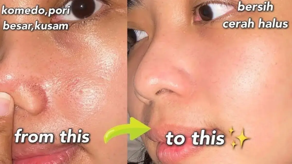 Produk Skincare untuk Mengatasi Komedo