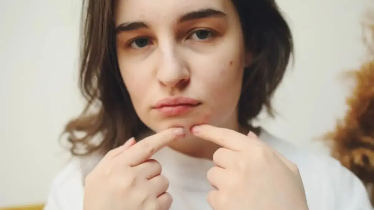 4 DIY Racikan Penghilang Jerawat yang Mudah Dibuat di Rumah, Bikin Wajah Bersih Kembali DIY Racikan Penghilang Jerawat