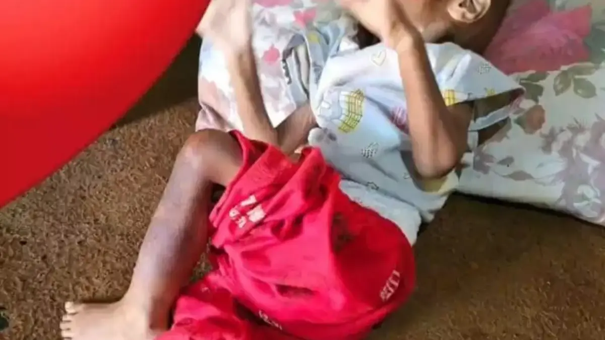 Memprihatinkan! Balita Gringsing Batang Alami Gizi Buruk, Usia 2 Tahun Berat Hanya 6,2 Kg