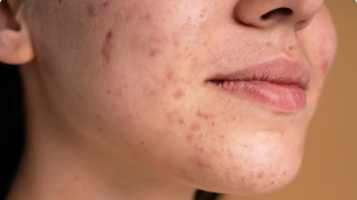 Mengatasi dan Memperbaiki Wajah Brutusan agar Kulit Menjadi Mulus Kembali dan Tips Menjaga Skin Barrier Mengatasi dan memperbaiki wajah brutusan